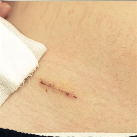 Appendix Removal Surgery 的图像结果