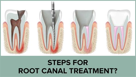 Single sitting root canal treatment