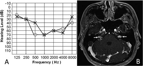 Bilateral simultaneous sudden sensorineural hearing loss - Journal of the Neurological Sciences