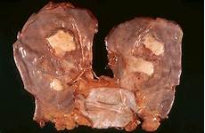 lung cancer photo all about asbestos healthy style foods habits fitness exercises what lung cancer photo all about asbestos healthy style foods habits fitness exercises what