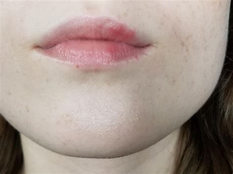 Help! Bumpy, textured, red patches on upper lip [Skin Concerns] : r ...