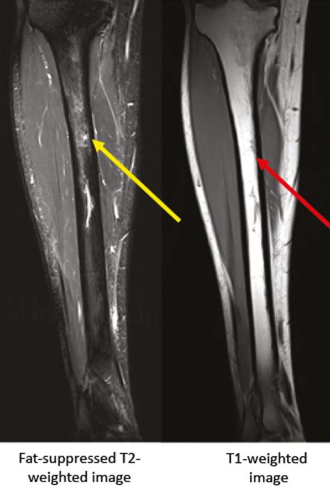 Medial Tibial Stress Syndrome Bone Scan