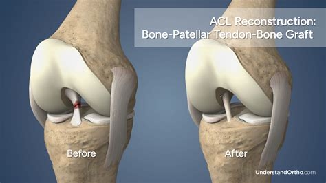 Torn ACL Reconstruction (BPTB Graft) – UnderstandOrtho™