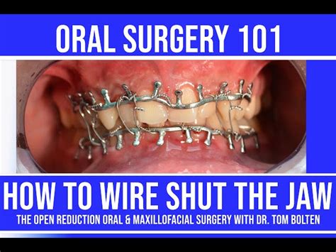 Disadvantages Of Jaw Wiring Maxillofacial Hardware Surgery T