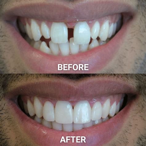 Veneers Quiz | Adelaide Cosmetic Dentistry