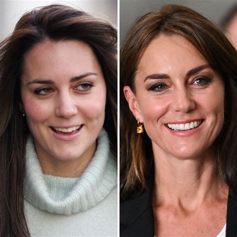 Did Kate Middleton Get Plastic Surgery? Is It Allowed in the Royal Family? - Plastic Surgery Turkey