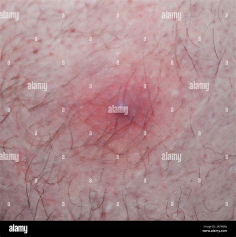 Folliculitis infection hi-res stock photography and images - Alamy