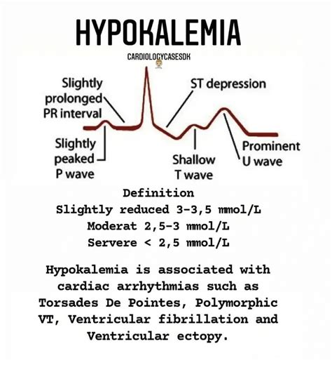 Hypokalemia Ecg