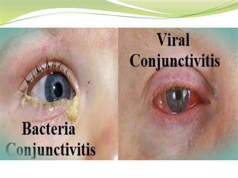 Conjunctivitis | PDF
