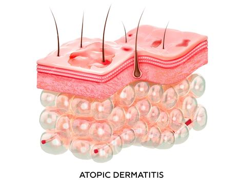 Eccema Ilustración 3d de la sección transversal de las capas de la piel con dermatitis atópica ...