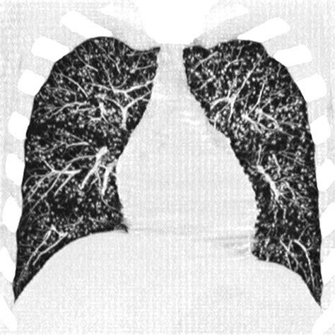 Tree-In-Bud Pattern | AJR