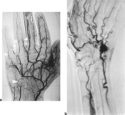 Figure 2 from Hypothenar Hammer Syndrome | Semantic Scholar