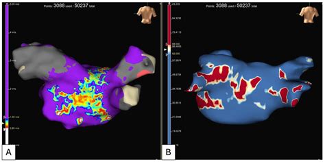 Catheter Ablation of Atrial Fibrillation: Technique and Future Perspectives