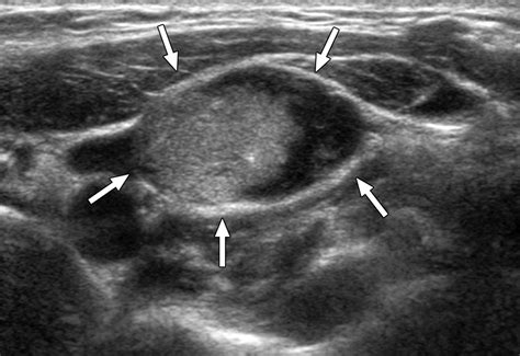 Diagnostic Approach for Evaluation of Lymph Node Metastasis From Thyroid Cancer Using Ultrasound ...