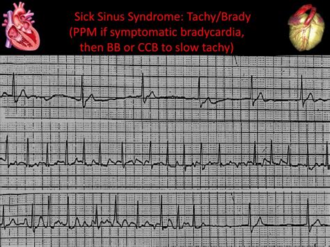 PPT - Cardiology Board Review EKGs PowerPoint Presentation, free download - ID:189406