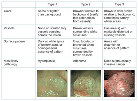 Colonoscopy Polyps Types Colon Cancer: A Growing Risk For Young And