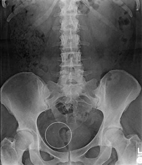 Phleboliths mistaken for intraperitoneal copper-containing intrauterine ...