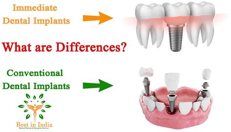 Conventional Dental Implantology at Wilbur Pritt blog