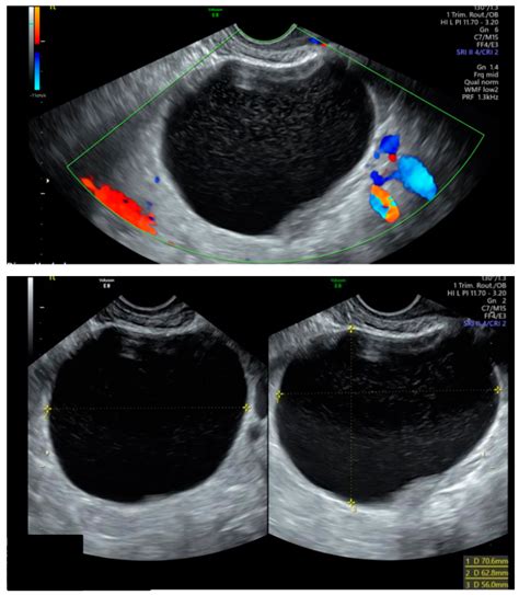 Ovarian Torsion Ultrasound