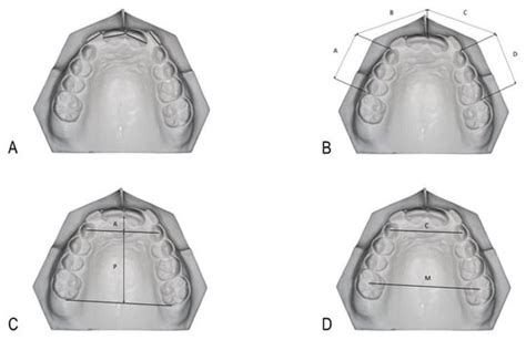 Association between Eruption Sequence of Posterior Teeth, Dental ...