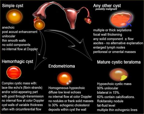 endometriosis ovarian cyst