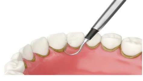 Dental Calculus Symptoms Risks & Treatment - Grove Dental Clinic