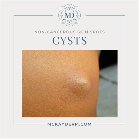 Understanding Non-Cancerous Skin Spots — and When to Consult a Dermatologist — McKay Dermatology ...