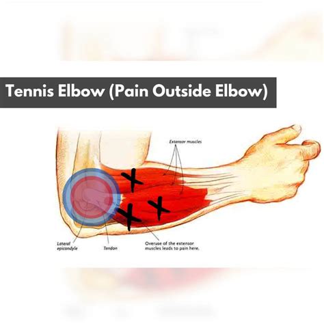 Why Does My Elbow Hurt When I Throw A Football at Edward Padgett blog