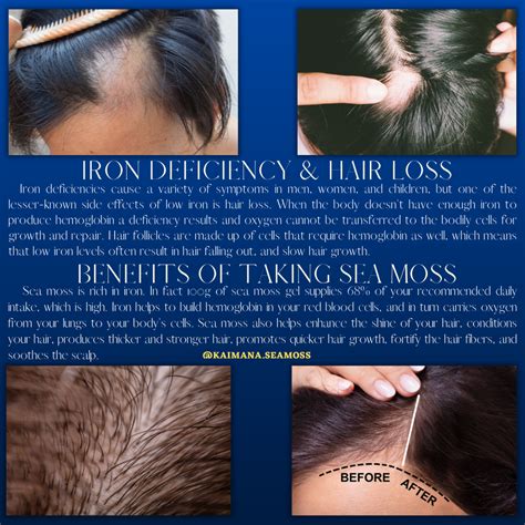 Zinc Deficiency And Hair Loss