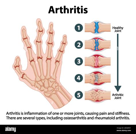 Illustrated infographic depicting stages of arthritis in human hand Stock Vector Image & Art - Alamy