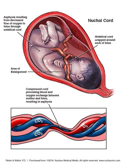Bildergebnis für umbilical cord wrapped around neck