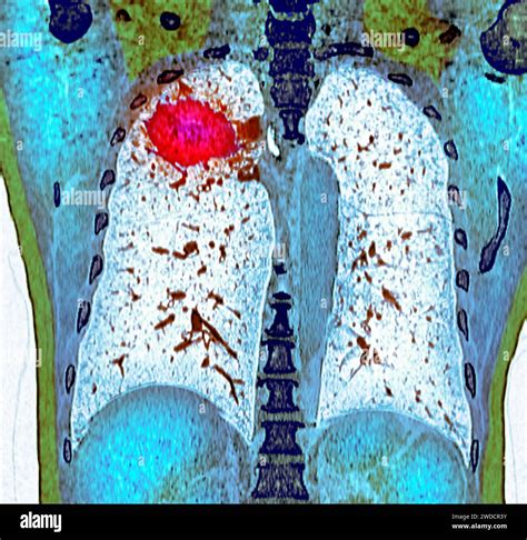 Lung cancer, CT scan Stock Photo - Alamy