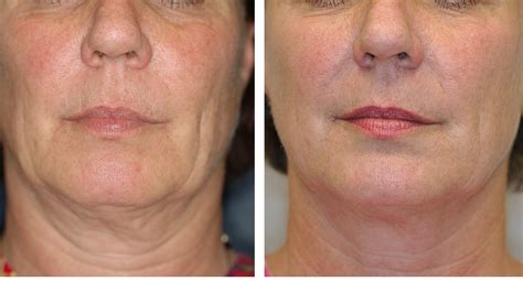 Thermage for non-surgical face lifts and to tighten loose skin was the no 1 choice to tighten ...