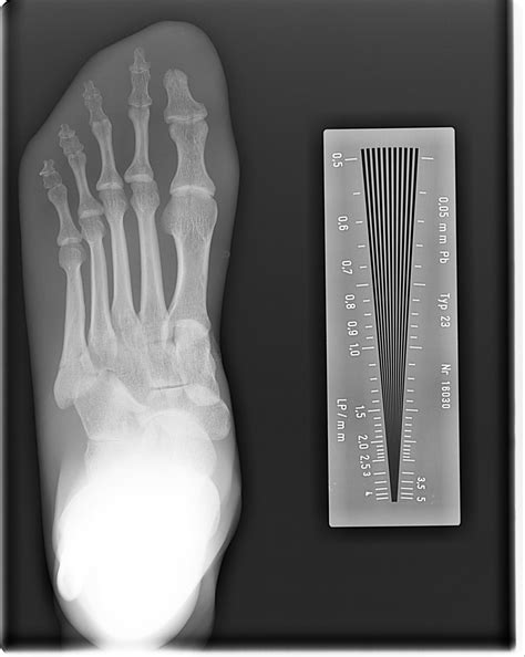 What Affects Spatial Resolution In Radiography
