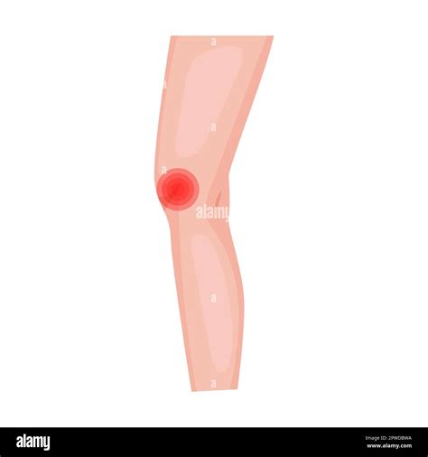 throbbing knee pain. Traumas of skin on body part. Vector illustration of open cut wounds with ...