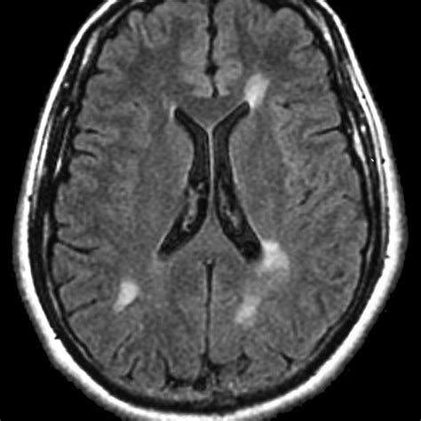 Plaques Brain Lesions at Harrison Fitch blog