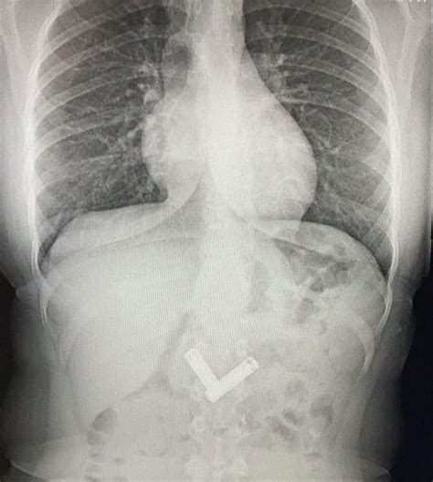 Hard and painless lump behind my ear. Anybody know what this is? : r/AskDoctorSmeeee