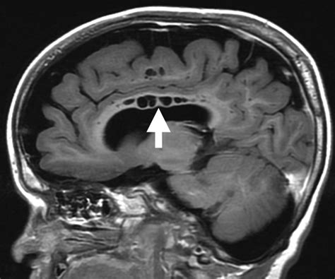 Corpus Callosum Funktion