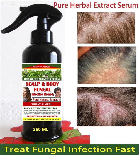 Scalp Fungus Treatment Home Remedies