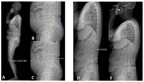 Spinal Flexibility Is an Important Factor for Improvement in Spinal and ...