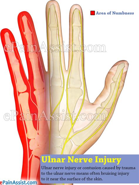 Ulnar Nerve Damage Symptoms