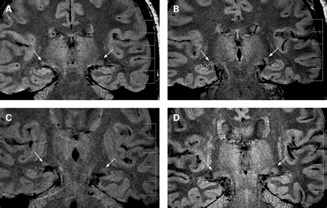 Lateral Geniculate Nucleus Mri