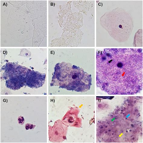 Clue Cells On Wet Prep