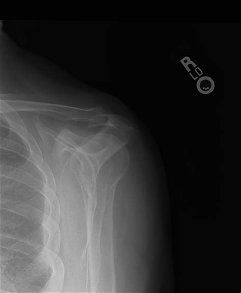 Shoulder X Ray Bone Spur at Kenneth Sensabaugh blog