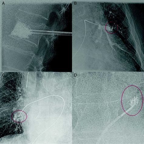 Embolia pulmonar múltiple tras vertebroplastia con polimetilmetacrilato, con evolución fatal a ...