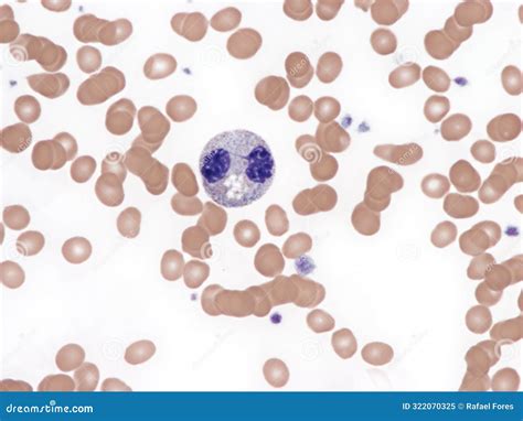 Neutrophil in Myelodysplastic Syndrome Stock Image - Image of medical, myelodysplastic: 322070325