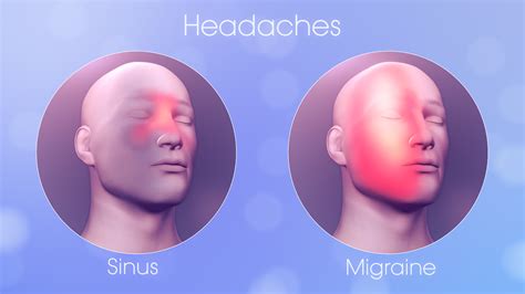 Sinus Headache vs Migraine: Spotting the Differences