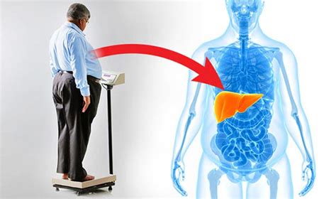 Threat grows from liver illness tied to obesity - India TV Hindi