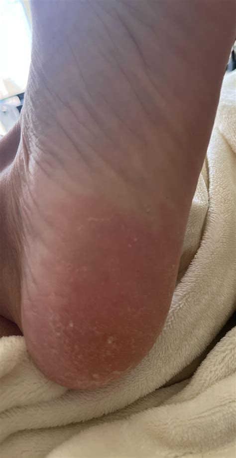 How long does it take to cure moccasin athletes foot? : r/NailFungus