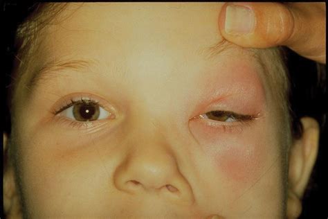 Cellulitis Under Eye Toddler